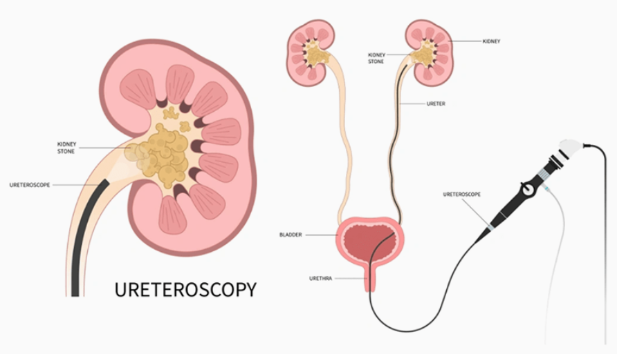 Flexible Ureteroscope