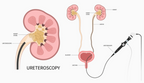 Flexible Ureteroscope